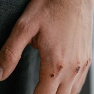 Lésions élémentaires en dermatologie